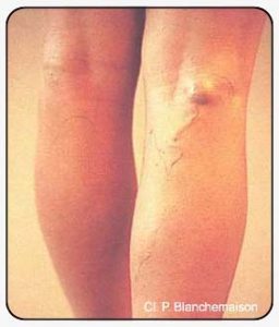 Figure 101 : Recurrence involving a perforating vein after saphenopopliteal junction ligation.