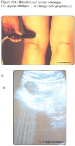 Figure 104: Récidive sur crosse ectasique (A: aspect clinique - B : image échographique).