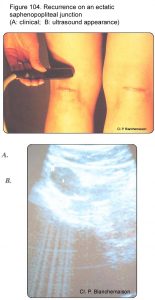 Figure 104. Recurrence on an ectatic saphenopopliteal junction (A: clinical appearance; B: ultrasound appearance).