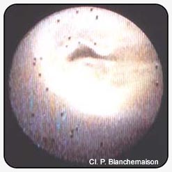 Figure 11. Valvular incompetence due to lengthening of the free edge of the valve