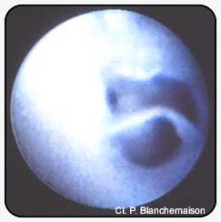 Figure 12. Tearing of the valvular cusp below the junction of an intramuscular perforating vein.