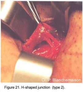 Figure 21. H-shaped junction, type 2.