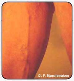 Figure 35 : Perineal veins and the long saphenous vein in a sportsman.