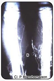 Figure 4 : Lower limb perforators shown by selective varicography with tourniquets.