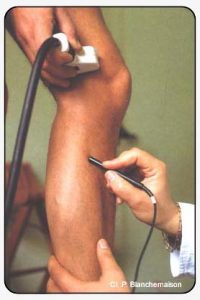 Figure 5. Combined ultrasonography-Doppler confirms the incompetence of a perforating vein (compression of the saphenous trunk under ultrasonographic control to eliminate ostial reflux).