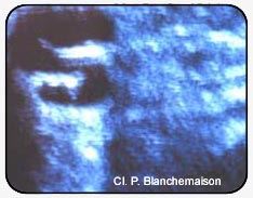 Figure 6. 2D ultrasonography identifies the site, course, and diameter of perforating veins.