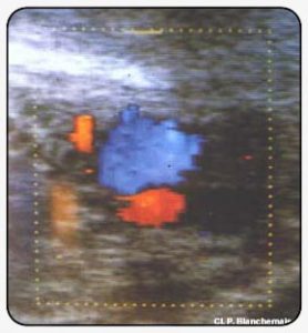 Figure 7. Ultrasonography-color Doppler. Superimposition of the superficial femoral vein and artery, with origin of an incompetent accessory saphenous vein.