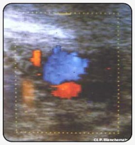 Figure 7. Ultrasonography-color Doppler.  Superimposition of the superficial femoral vein and artery, with origin of  an incompetent accessory saphenous vein.