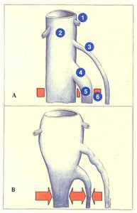 Figure 75. Conséquences de la dilatation des veines jumelles sur la veine poplitée.