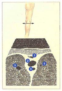 Figure 76. Popliteal fossa appearance upon ultrasound.