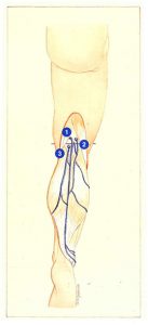 Figure 77. Classical anatomical position of the saphenopopliteal junction. Associated reflux in the popliteal fossa.