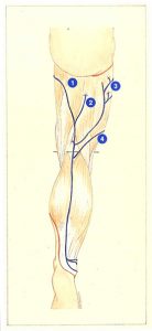 Figure 78. Classical anatomical position of the saphenopopliteal junction. Associated reflux derived from the thigh.