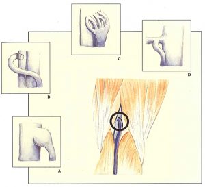 Figure 79. Classical anatomical position of the saphenopopliteal junction, but with an atypical morphology.