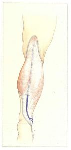 Figure 82: Pénétration transaponévrotique du tronc saphène externe au tiers moyen de la jambe.
