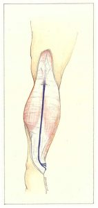 Figure 83: Pénétration transaponévrotique du tronc saphène externe au tiers supérieur de la jambe.