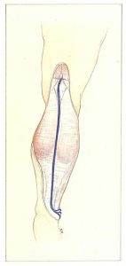 Figure 84: Transfascial penetration of the short saphenous vein in the popliteal fossa.