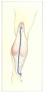 Figure 84: Pénétration transaponévrotique du tronc saphène externe au creux poplité.