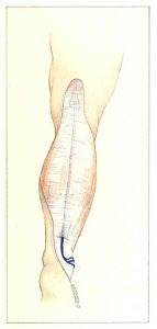 Figure 85: Pénétration transaponévrotique du tronc saphène externe au tiers inférieur de la jambe.