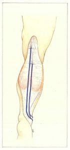 Figure 86. Dédoublement saphène externe en un plan.