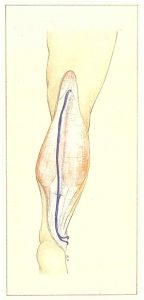 Figure 87. Duplication of the short saphenous vein in two superimposed planes.