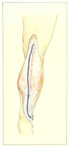 Figure 87. Dédoublement saphène externe en deux plans superposés.