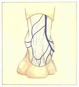 Figure 89. Classical origin of the short saphenous vein.
