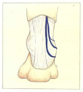 Figure 90. Two-vessel origin of the short saphenous vein.