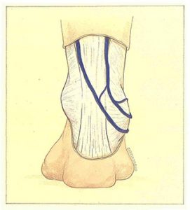 Figure 91. Origin of the short saphenous vein related to the long saphenous vein.