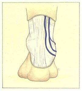 Figure 92. Origin of the short saphenous vein accompanied by a duplicated vein.