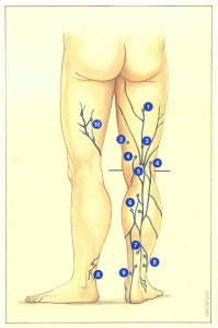 Figure 93. Perforating veins of the short saphenous territory. General aspect.