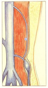 Figure 95. Tronc sous-aponévrotique parallèle à la peau (A).