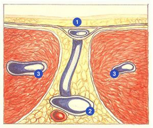 Figure 97. Direct perforating vein.