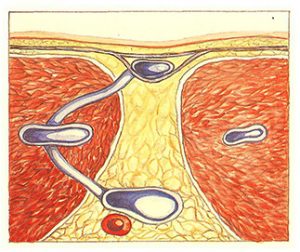 Figure 98. Veine perforante indirecte.