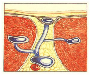 Figure 99. Veine perforante ramifiée.