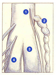 Figure 102A. Recurrence involving an ectatic gastrocnemius vein