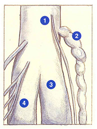 Figure 102A. Récidive sur veine jumelle ectasique.