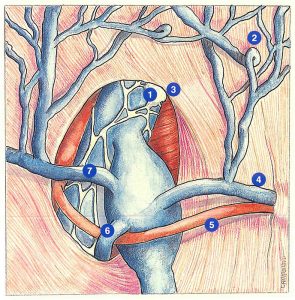 Figure 13. Ectasia of the saphenofemoral junction (type 1).