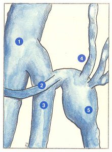 Figure 20: Crosse en H (vue latéro-externe). Type 1.