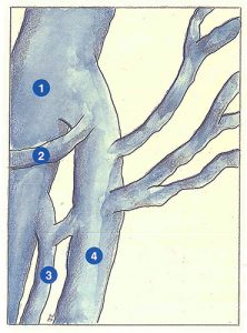 Figure 22: Crosse en H (vue latéro-externe). Type 2.