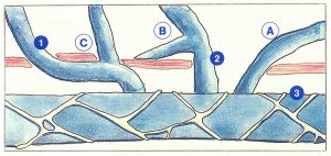 Figure 23: Trois modes d'abouchement inhabituel des veines collatérales de drainage cutané.