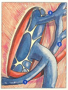 Figure 24. Direct drainage into the femoral vein