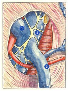 Figure 28: Abouchement d'une veine circonflexe profonde dans la veine fémorale commune. 