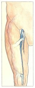 Figure 29: Hypotrophie de la veine fémorale  superficielle et ses conséquences anatomiques. 