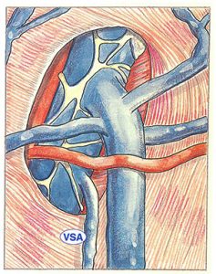 Figure 32. Accessory saphenous vein (ASV). Anastomosis into the femoral vein below the arch of the long saphenous vein.