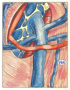 Figure 34: Accessory saphenous vein (ASV).  Anastomosis into a tributary of the arch of the long saphenous vein.