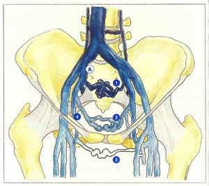 Figure 37: Voies de suppléance au cours d'une thrombose iliaque.