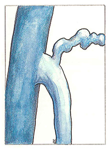 Figure 38: Varices sus-pubiennes.  Abouchement dans la crosse saphène interne.