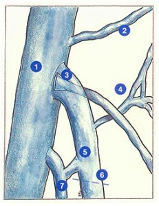 Figure 41: Causes anatomiques et hémodynamiques des récidives post-chirurgicales à l'aine.