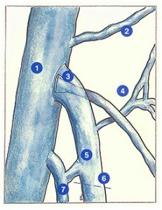 Figure 41. Anatomical and hemodynamic causes of recurrences following groin surgery (the meaning of the numbers is indicated in the text).