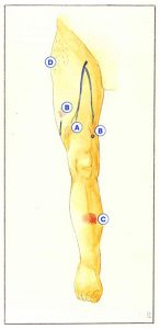 Figure 45. Pathogenesis of intradermal varicosities (A to D: see text).